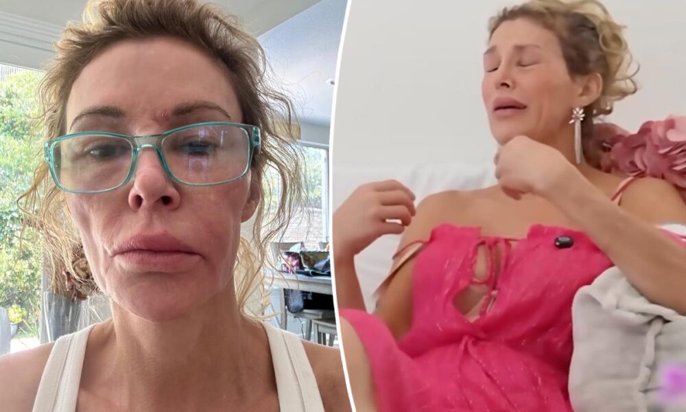 Brandi Glanville breaks down over GoFundMe as she faces ongoing facial disfigurement