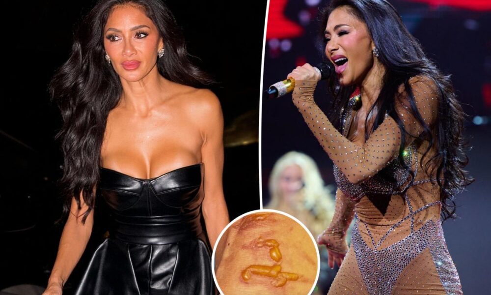 Nicole Scherzinger shows off gruesome injury after ‘boiling water’ fell on her leg 1 hour before concert
